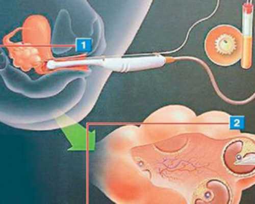 国内供卵公司排名榜最新,国内做第二代试管婴儿需要什么戳，对女性的要求不可不知